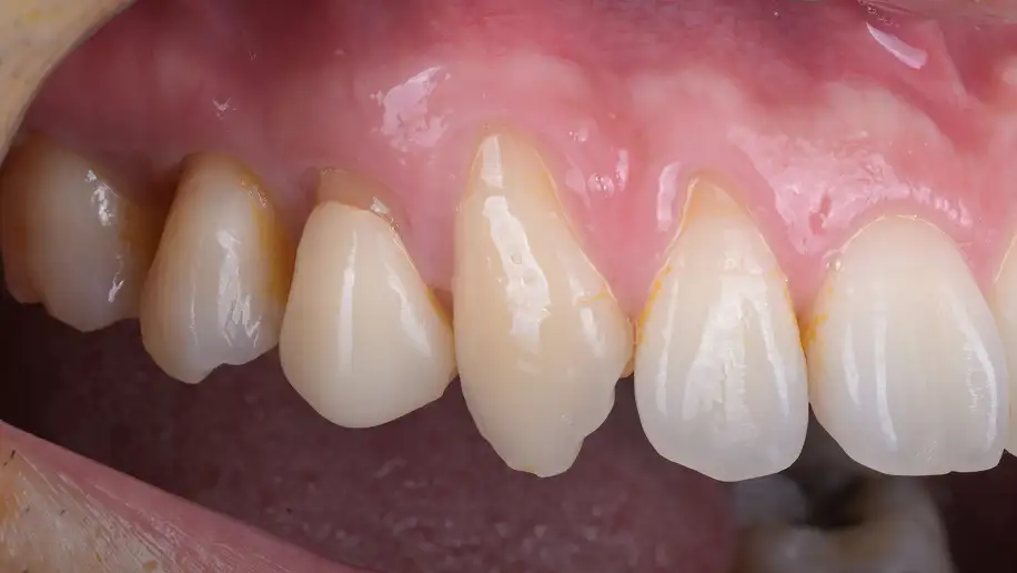 서울심도치과의원 잇몸 재생 치료 | 다수 치아 잇몸의 재생 치료 증례