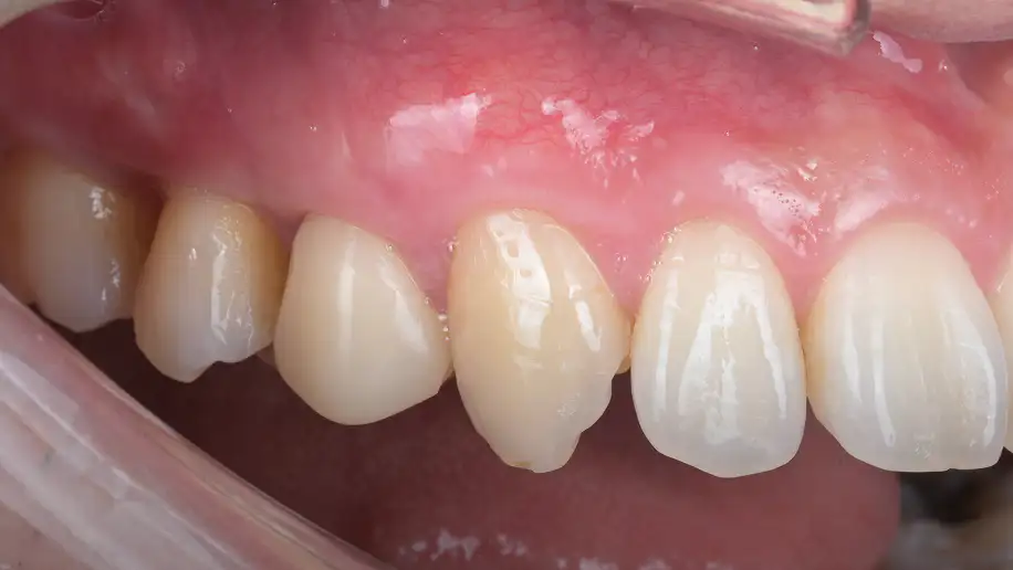 서울심도치과의원 잇몸 재생 치료 | 다수 치아 잇몸의 재생 치료 증례