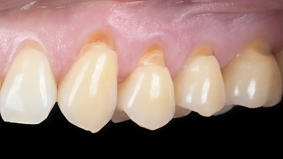 서울심도치과의원 잇몸 재생 치료 | 다수 치아의 치경부 마모증을 동반한 잇몸 퇴축의 치료 증례