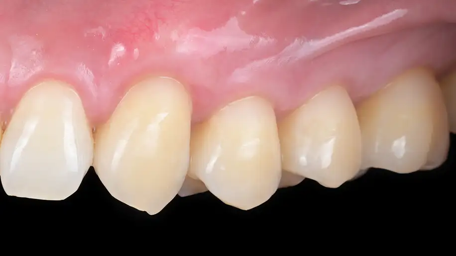 서울심도치과의원 잇몸 재생 치료 | 다수 치아의 치경부 마모증을 동반한 잇몸 퇴축의 치료 증례