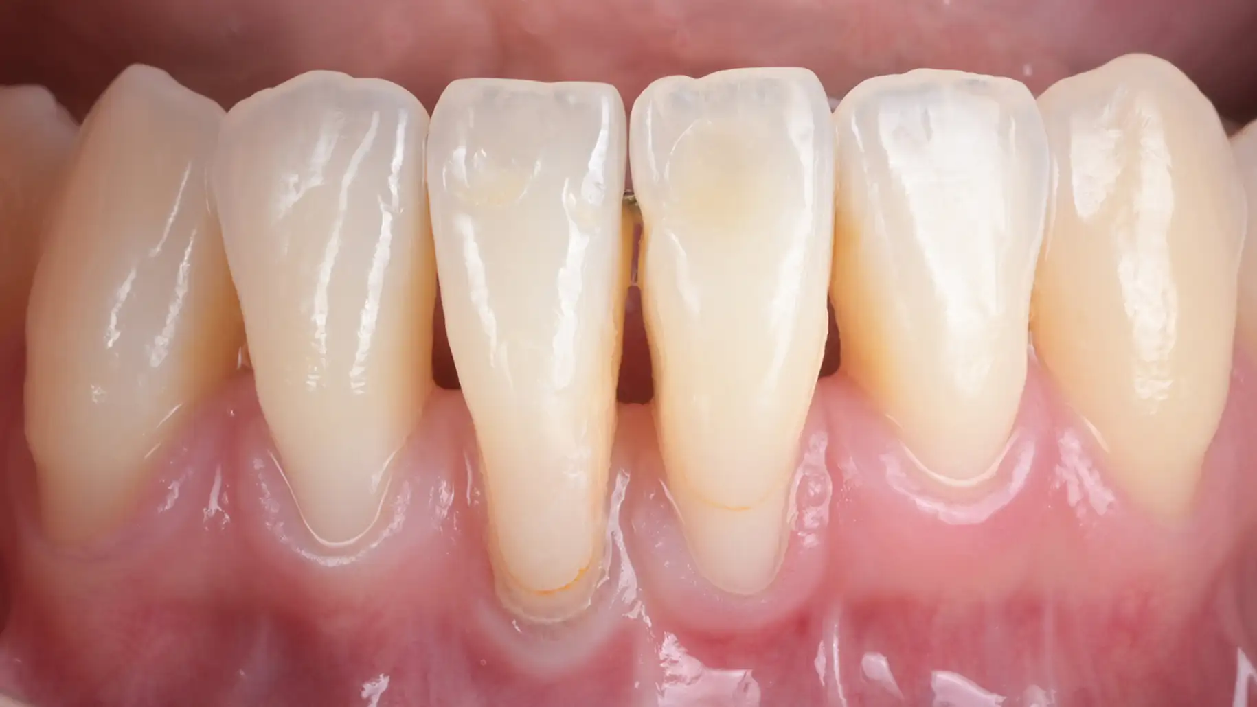 서울심도치과의원 잇몸 재생 치료 | 잇몸 퇴축은 발견 즉시 치료하는 것을 권고