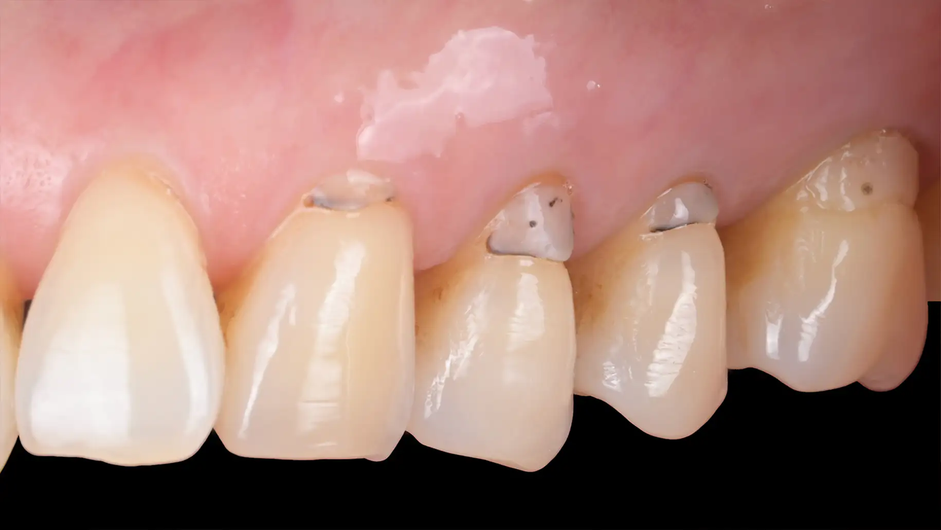 서울심도치과의원 잇몸 재생 치료 | 레진으로만 치료된 치은퇴축 부위를 재치료를 통해 재건한 치료 증례