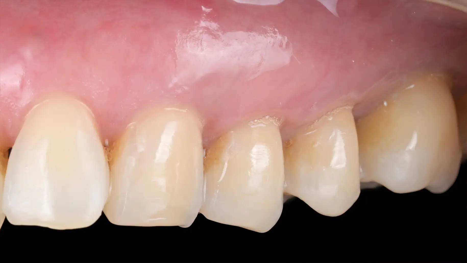 서울심도치과의원 잇몸 재생 치료 | 레진으로만 치료된 치은퇴축 부위를 재치료를 통해 재건한 치료 증례