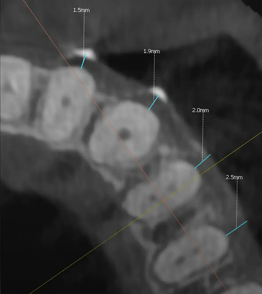 서울심도치과의원 잇몸 재생 치료 | 레진으로만 치료된 치은퇴축 부위를 재치료를 통해 재건한 치료 증례