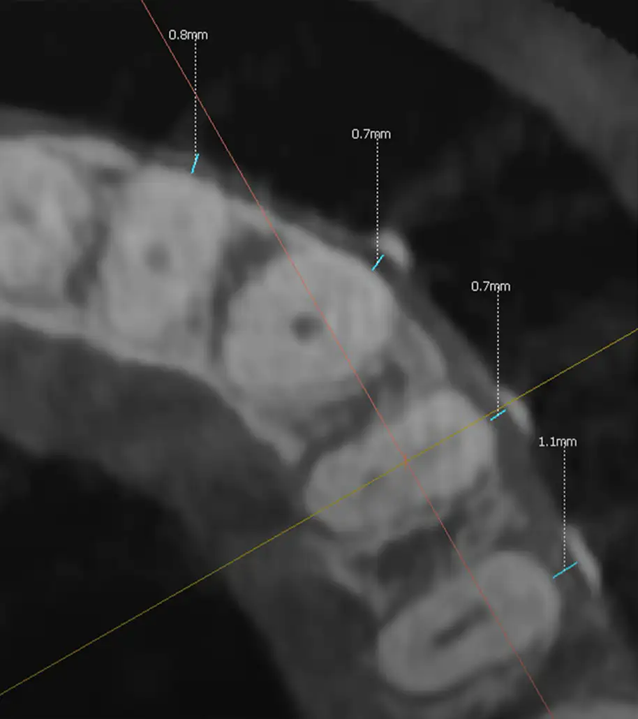 서울심도치과의원 잇몸 재생 치료 | 레진으로만 치료된 치은퇴축 부위를 재치료를 통해 재건한 치료 증례