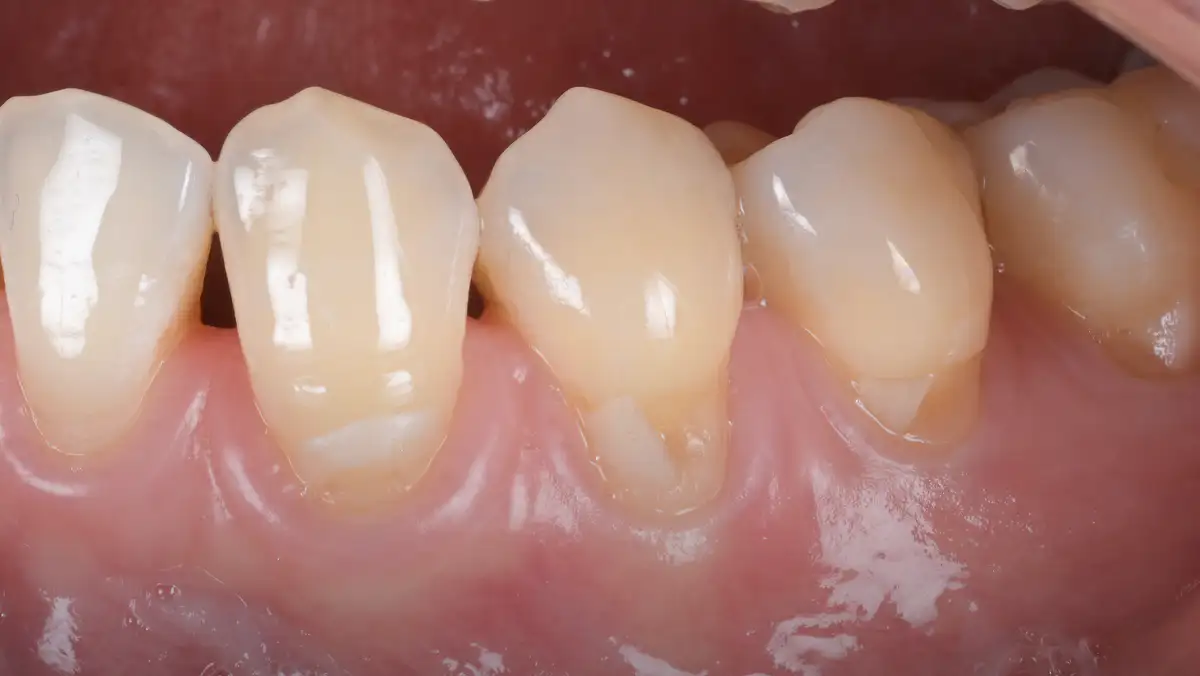 서울심도치과의원 잇몸 재생 치료 | 치아 패임과 잇몸 퇴축, 단순 레진 충전을 넘어선 해부학적 재건 치료 STEP 01 치아 패임 및 잇몸 퇴축 확인