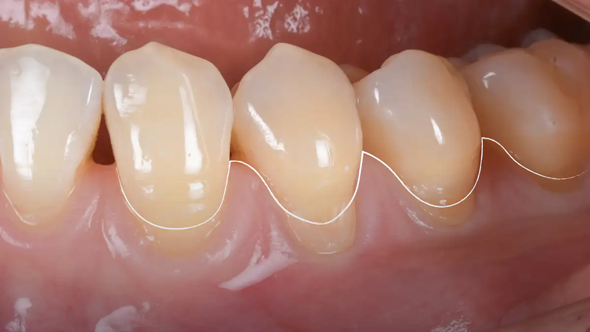 서울심도치과의원 잇몸 재생 치료 | 치아 패임과 잇몸 퇴축, 단순 레진 충전을 넘어선 해부학적 재건 치료 STEP 02 퇴축된 잇몸을 덮고 있던 파절된 기존 레진 수복물 제거 후 회복시킬 잇몸 라인 설계