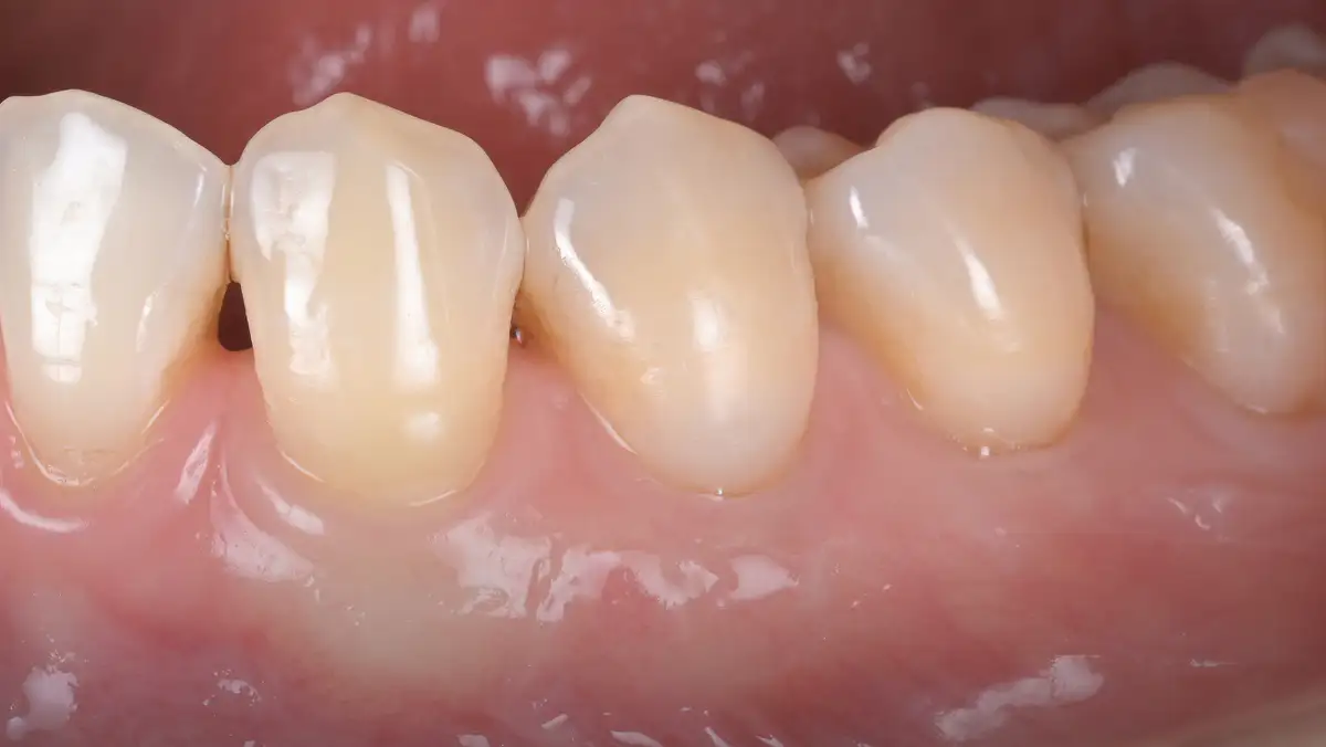 서울심도치과의원 잇몸 재생 치료 | 치아 패임과 잇몸 퇴축, 단순 레진 충전을 넘어선 해부학적 재건 치료 STEP 03 치아가 파인 부분은 레진으로 수복하고, 퇴축된 잇몸은 다시 회복