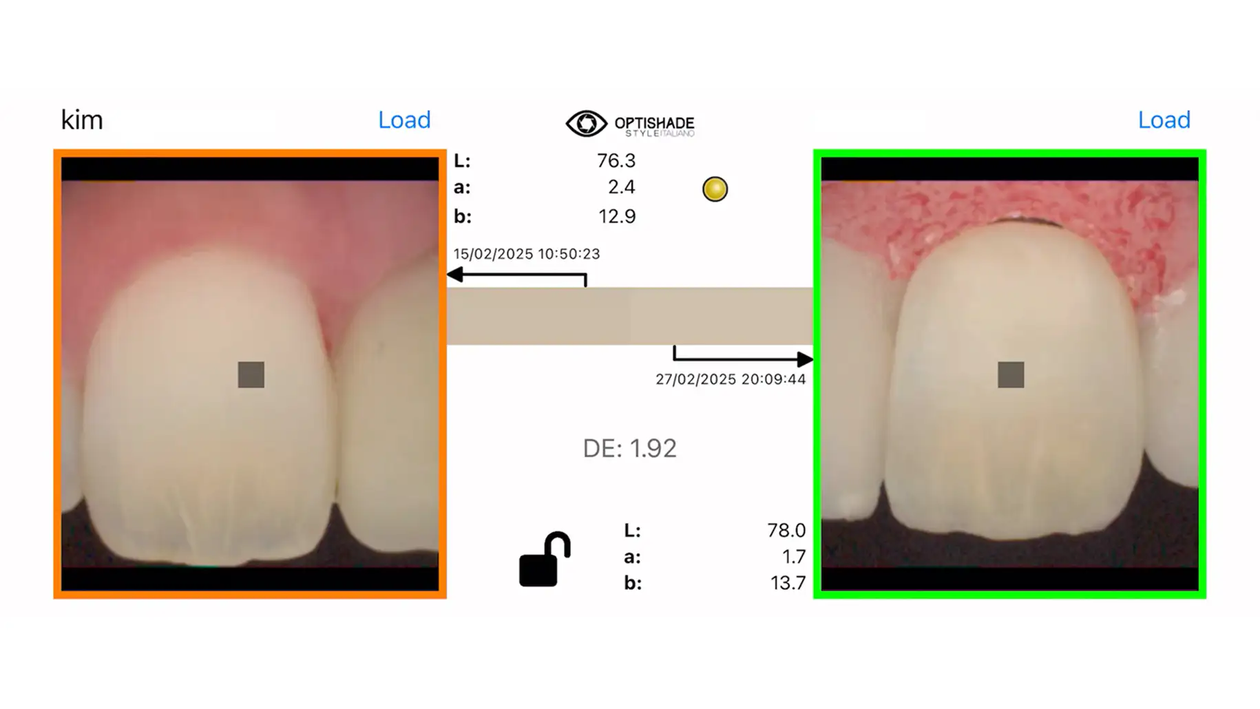 서울심도치과의원 앞니 임플란트 | 자연치와 같은 형태와 색의 재현
