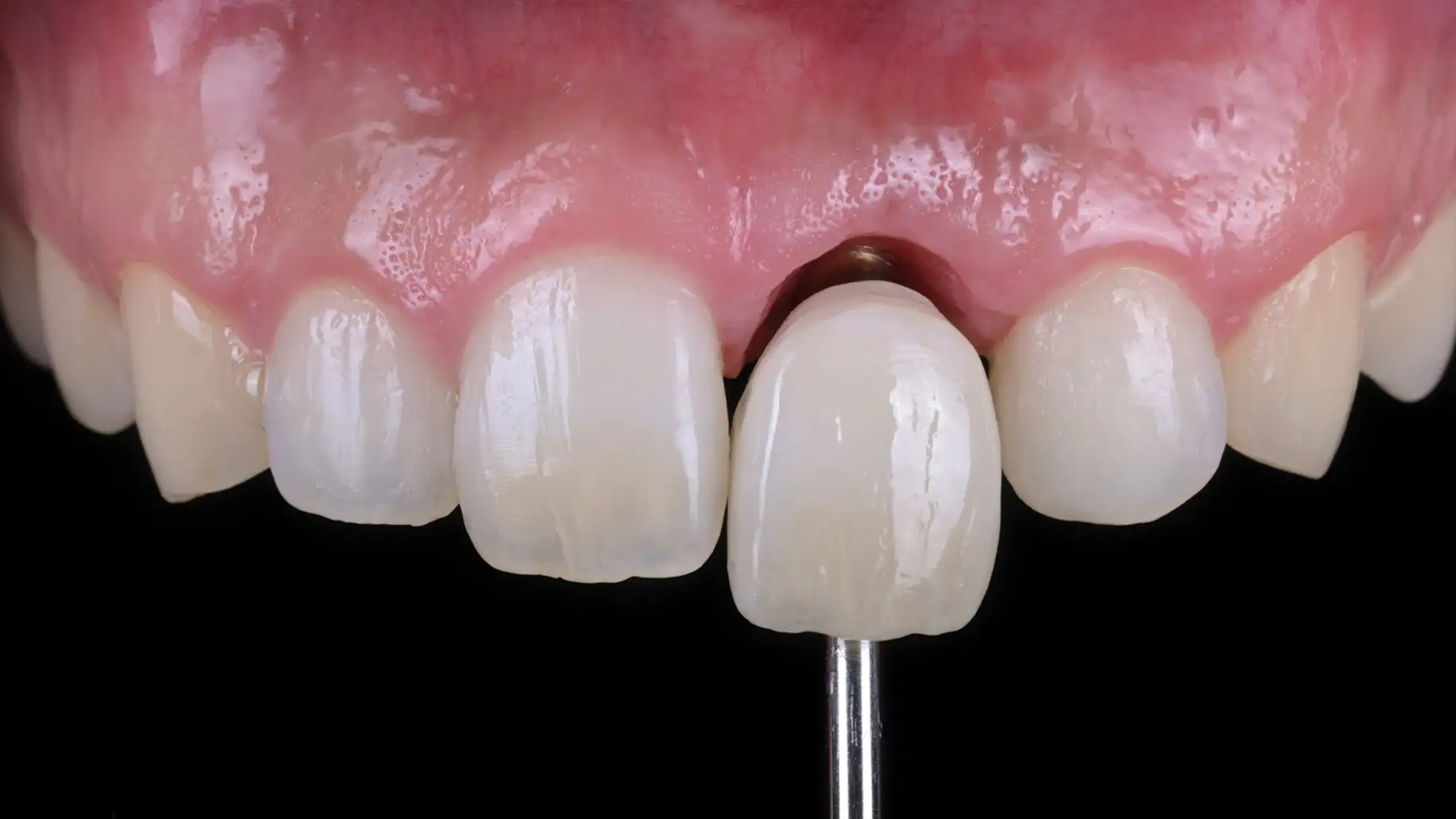 서울심도치과의원 앞니 임플란트 | 자연치와 같은 형태와 색의 재현