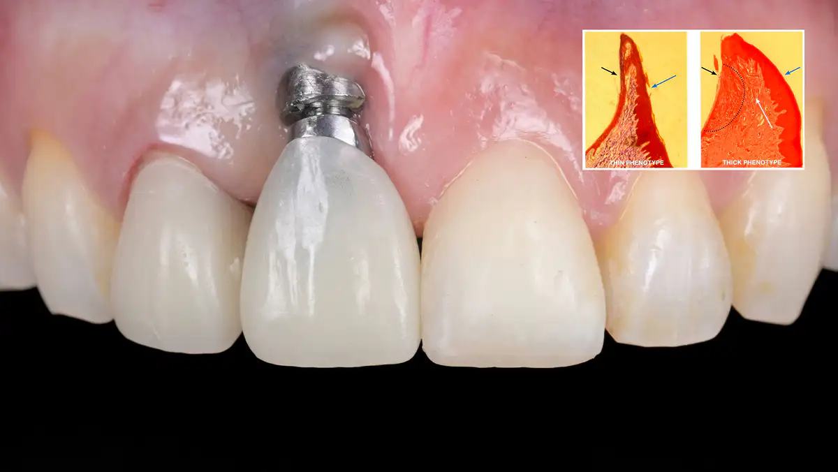 실패가 가장 눈에 띄는 자리, 앞니 임플란트