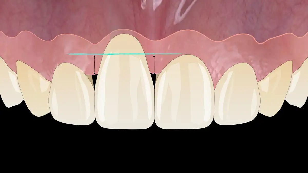 서울심도치과의원 앞니 임플란트 | 잇몸 볼륨 유지 및 조화 구현 치료 필수영역