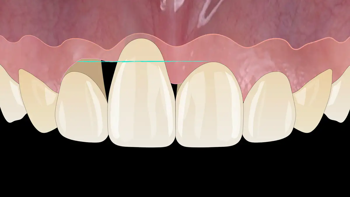 서울심도치과의원 앞니 임플란트 | 잇몸 볼륨 유지 및 조화 구현 치료 필수영역