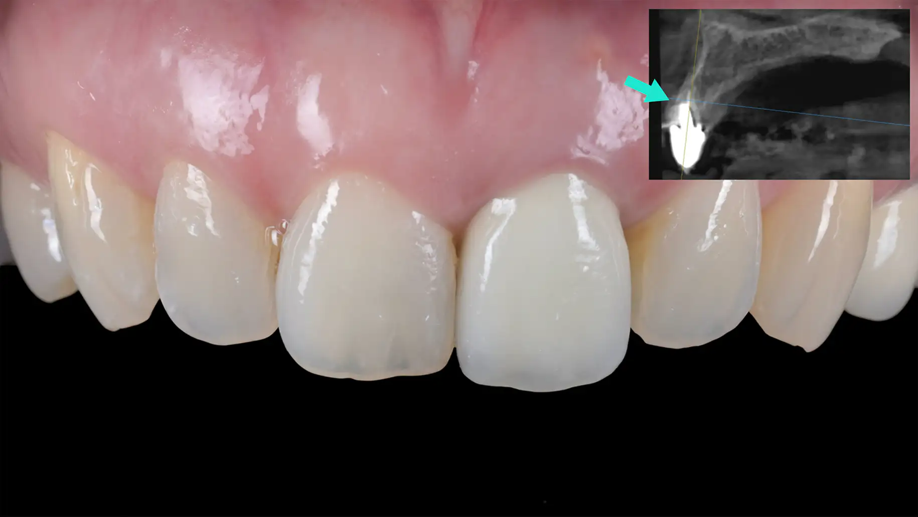 서울심도치과의원 앞니 임플란트 | 정확한 식립, 충분한 뼈와 연조직 두께의 확보, 단단한 각화 치은, 보철물의 적절한 잇몸 지지 형태 사례