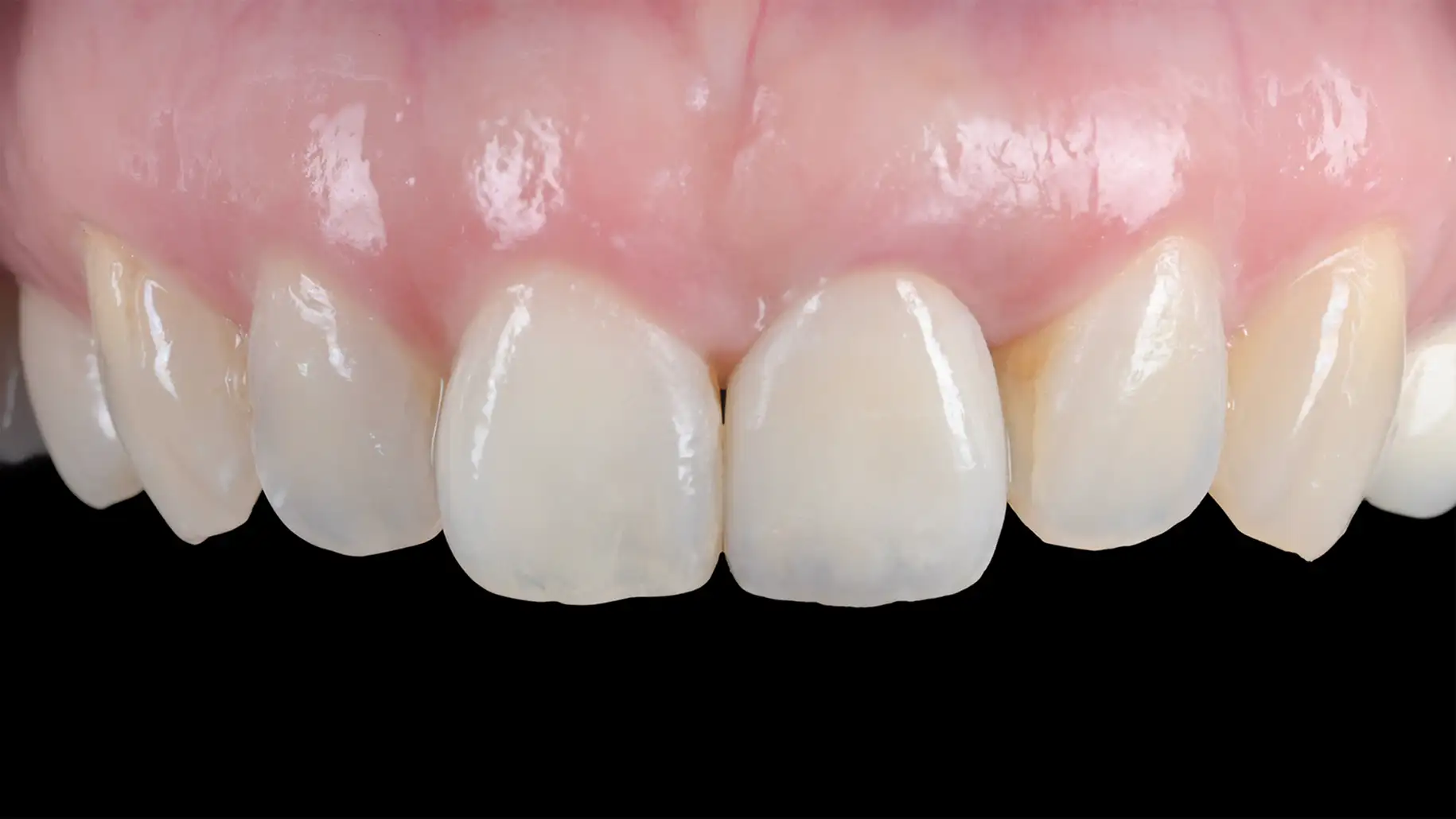 서울심도치과의원 앞니 임플란트 | 정확한 식립, 충분한 뼈와 연조직 두께의 확보, 단단한 각화 치은, 보철물의 적절한 잇몸 지지 형태 사례