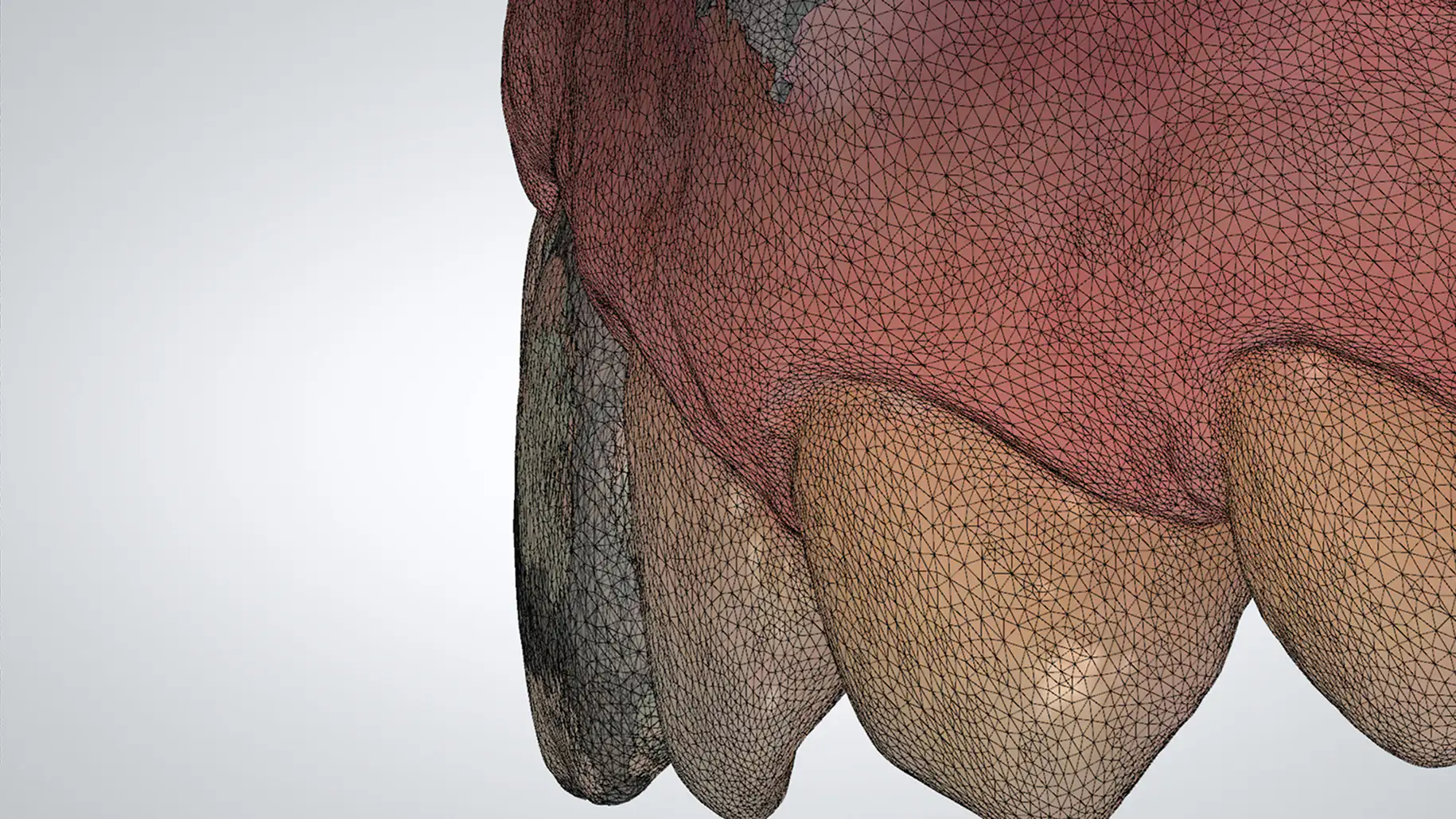 서울심도치과의원 앞니 임플란트 | 최신 연조직 수술, 정밀 보철 조정, 잇몸 볼륨 보완, 안정적인 잇몸 라인 회복