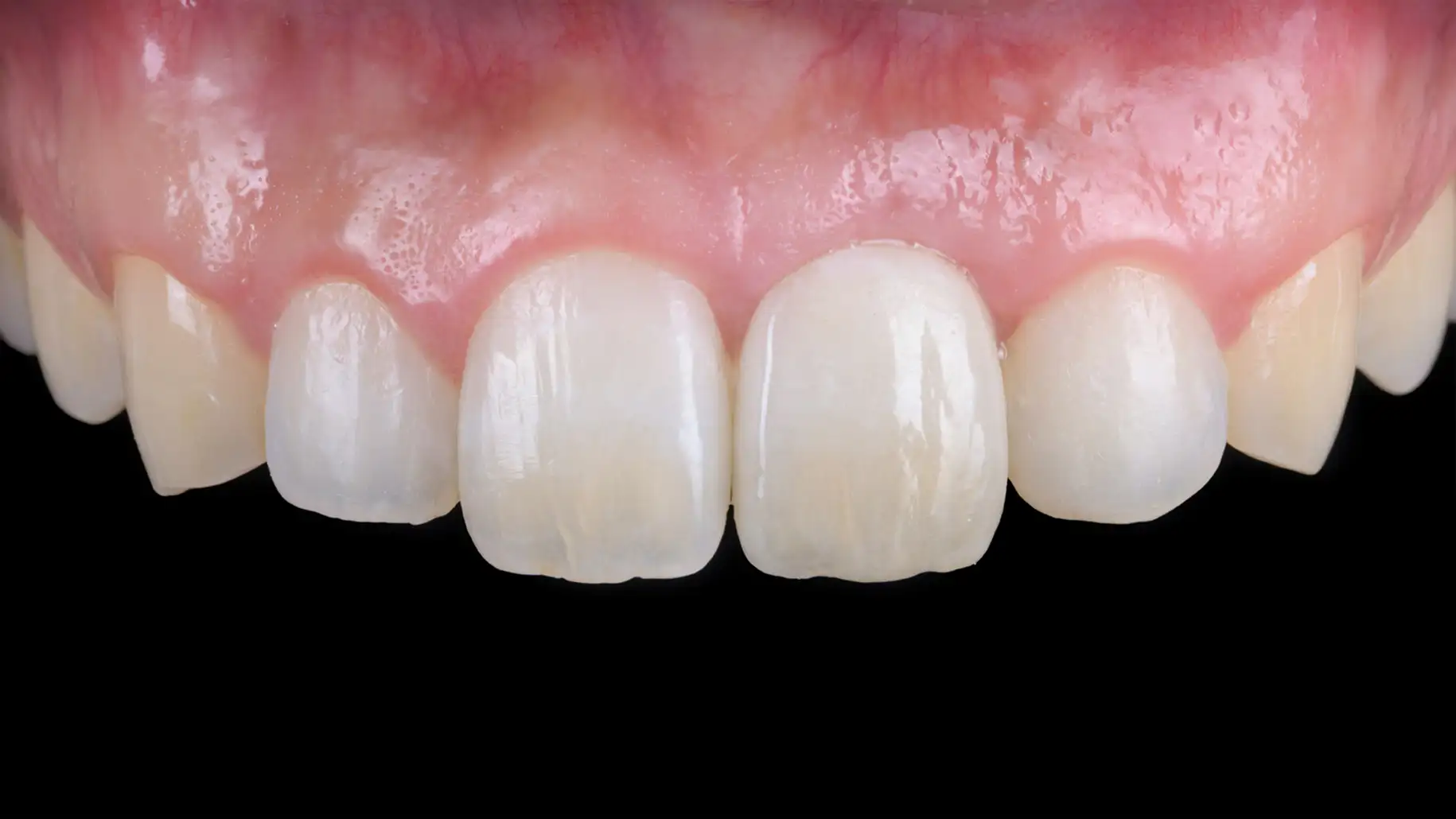 서울심도치과의원 앞니 임플란트 | 외상에 의해 잃어버린 앞니의 심미적 재건