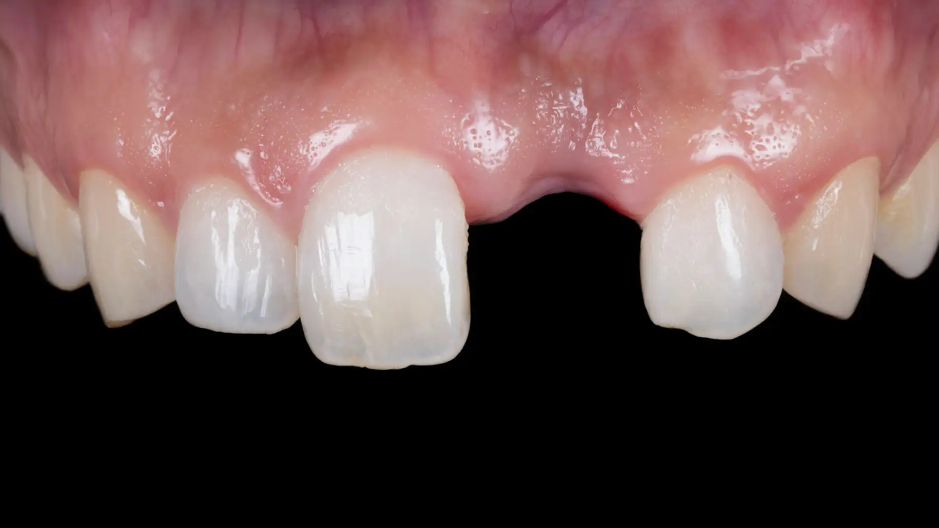 서울심도치과의원 앞니 임플란트 | 외상에 의해 잃어버린 앞니의 심미적 재건