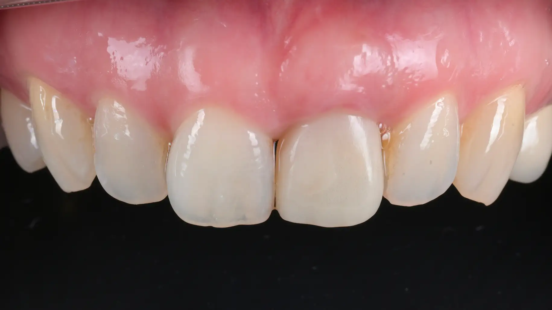 서울심도치과의원 앞니 임플란트 | 맞춤형 임시 치아로 공백 없는 일상 회복