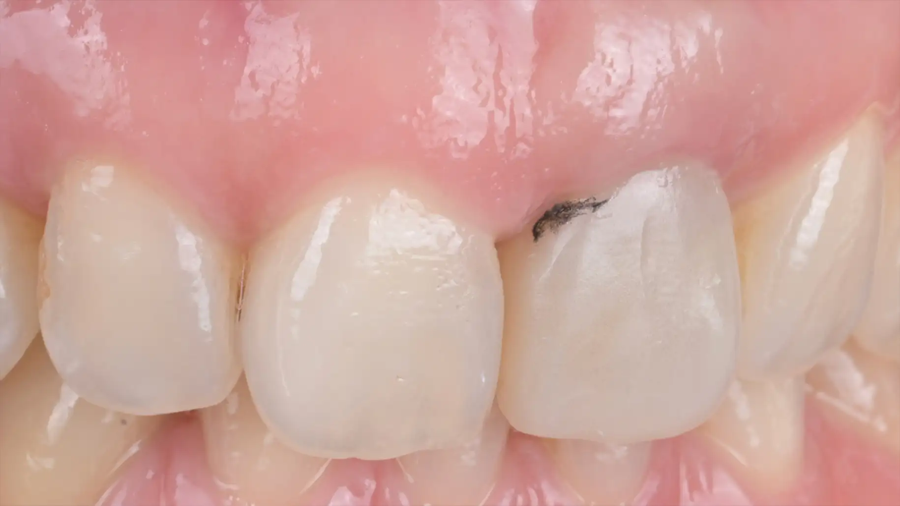 서울심도치과의원 앞니 임플란트 | 맞춤형 임시 치아 세밀한 조정 과정