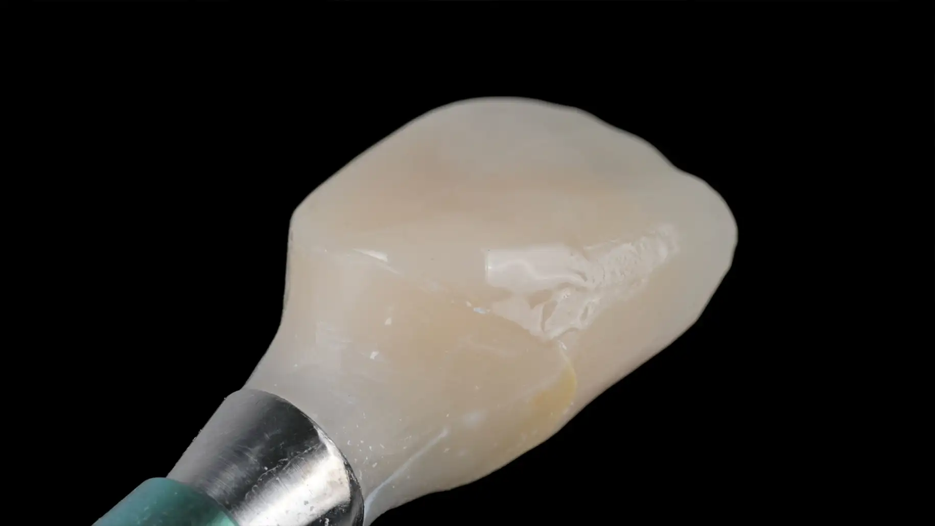 서울심도치과의원 앞니 임플란트 | 맞춤형 임시 치아 세밀한 조정 과정