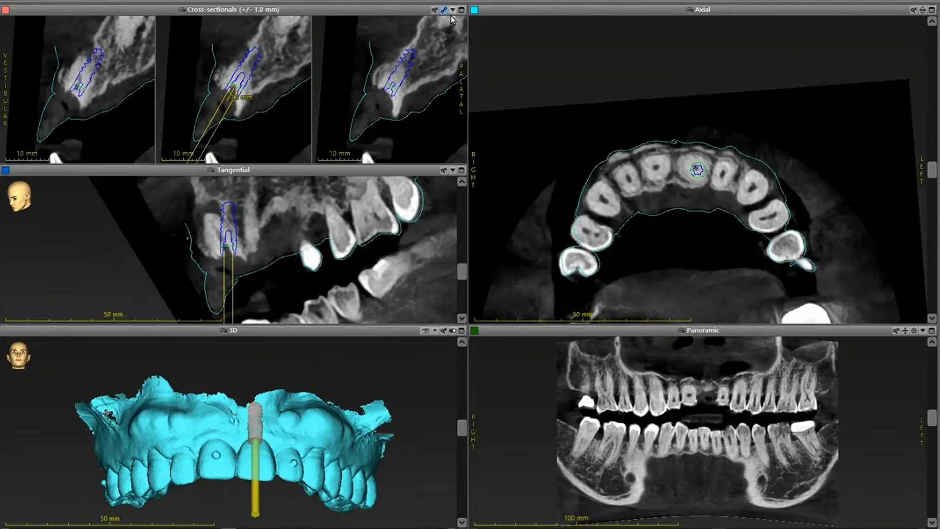 서울심도치과의원 앞니 임플란트 | 삼차원 디지털 분석 | 3D CT와 구강 스캐너를 활용하여 치조골과 주변 치아의 관계를 입체적으로 분석