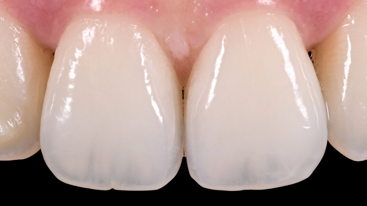 치아 색, 내부 구조 자연의 설계 정교