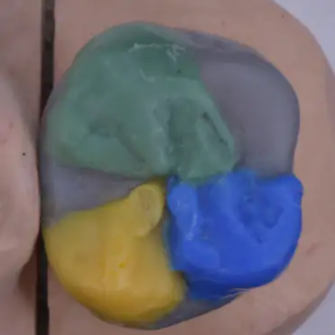 자연치아 편안하고 안정된 기능 | 환자 개개인에게 꼭 맞는 기능적 회복을 제공