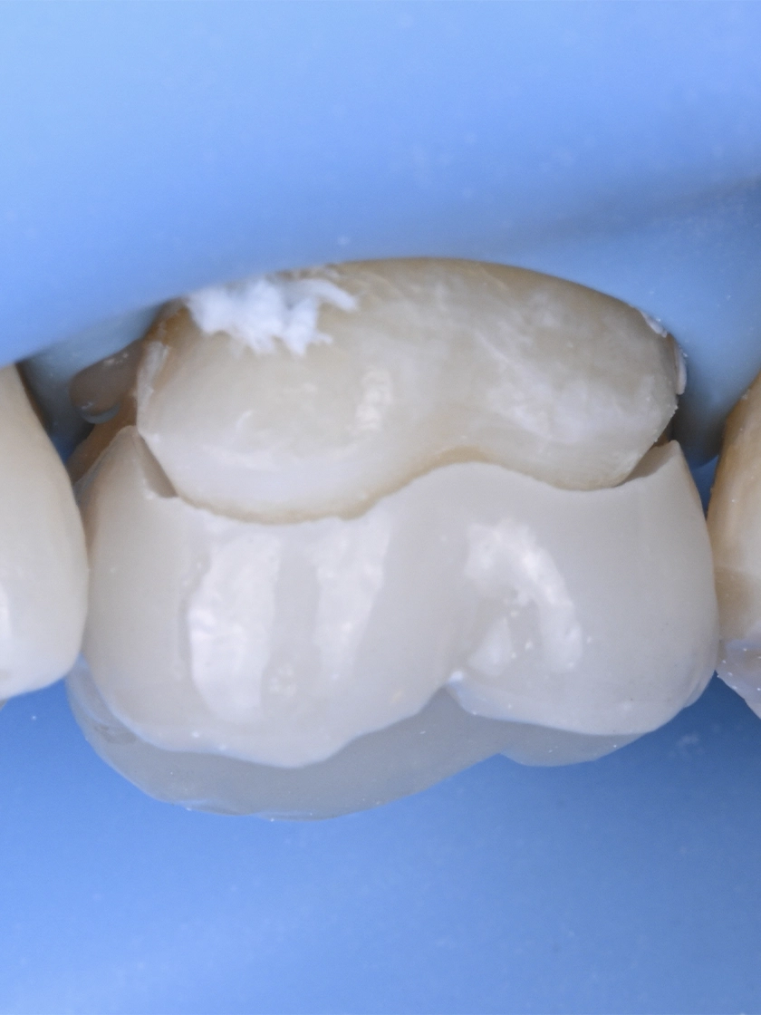 신경치료 후 크라운 vs 오버레이, 내 치아에 맞는 선택법