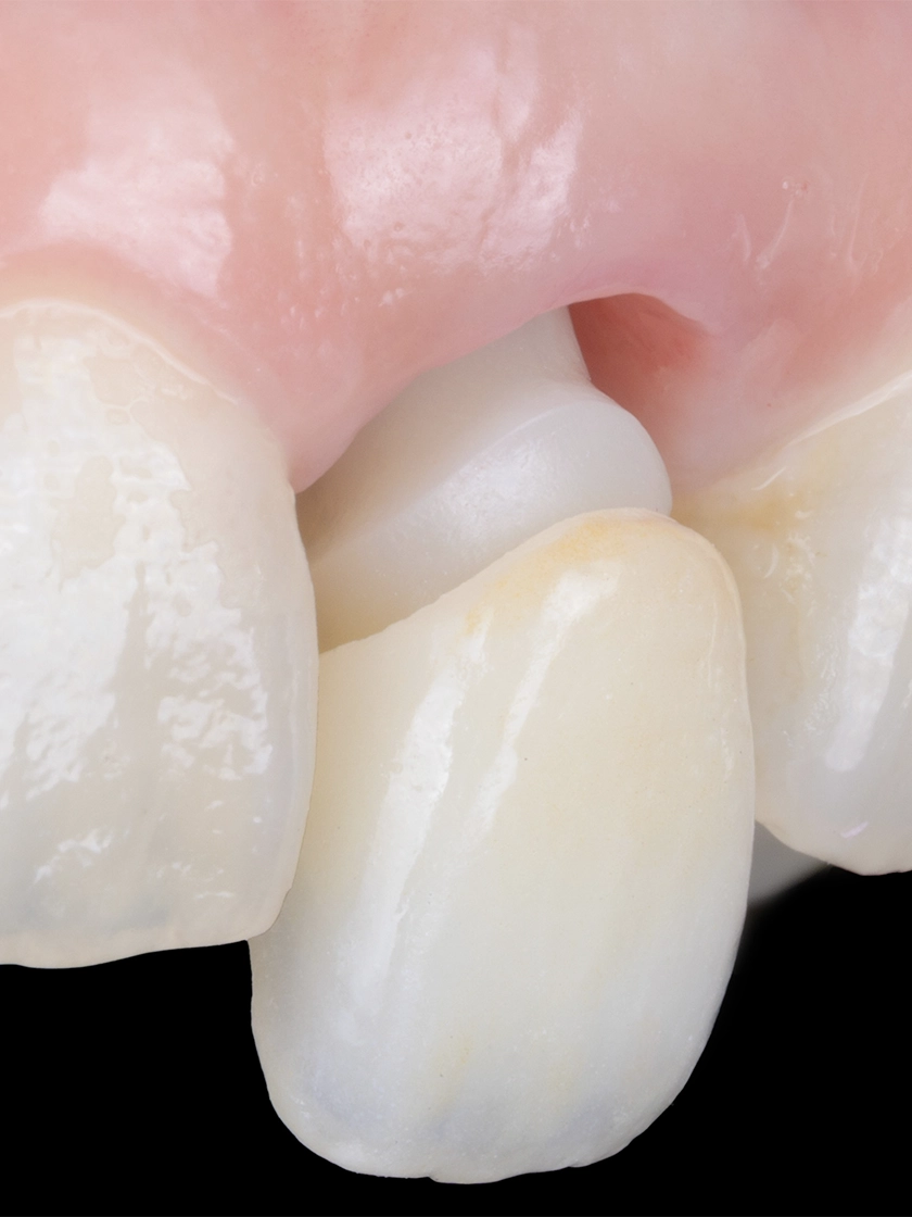 앞니 임플란트의 성공 조건, 연조직 이식