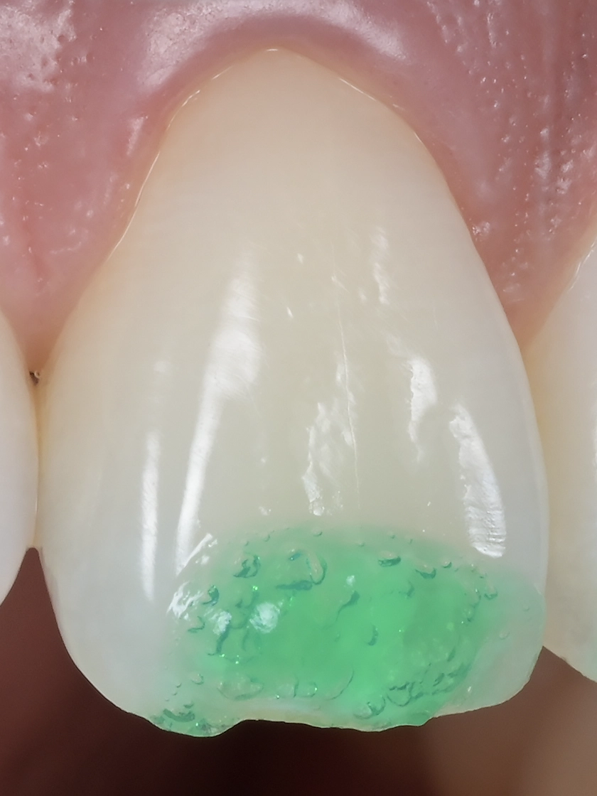 아이콘 레진, 치아 흰 반점 고민 해결 가이드