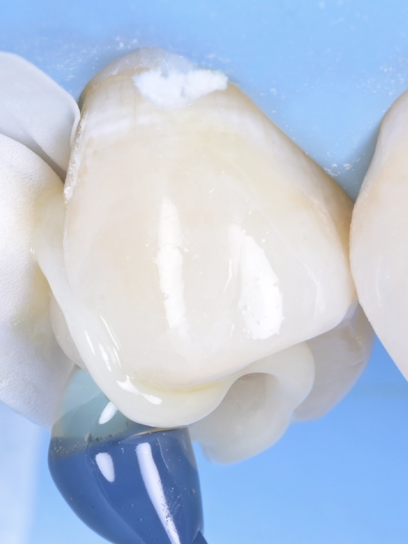 인레이 온레이 차이점 완벽 정리! 내게 맞는 치료법은?