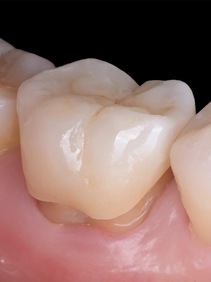 치과 크라운 치료, 필요한 상황과 단계별 과정