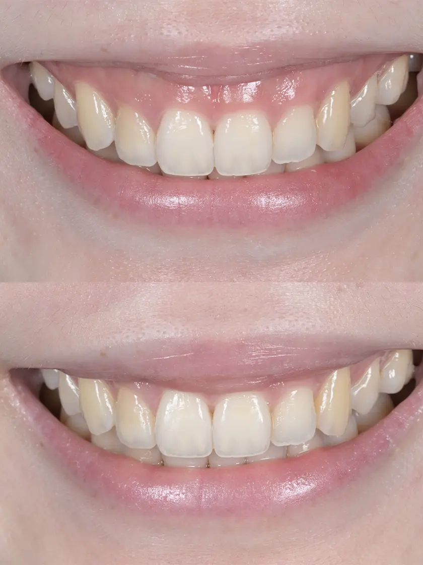 거미스마일(Gummy smile)과 입술 재배치술, 최신 치료 가이드