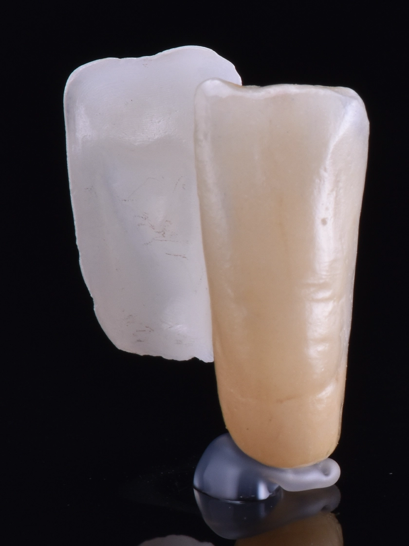 임플란트를 할 수 없는 상황에 선택할 수 있는 치료 방법, 레진 접착 브릿지(Resin Bonded Bridge, RBB)